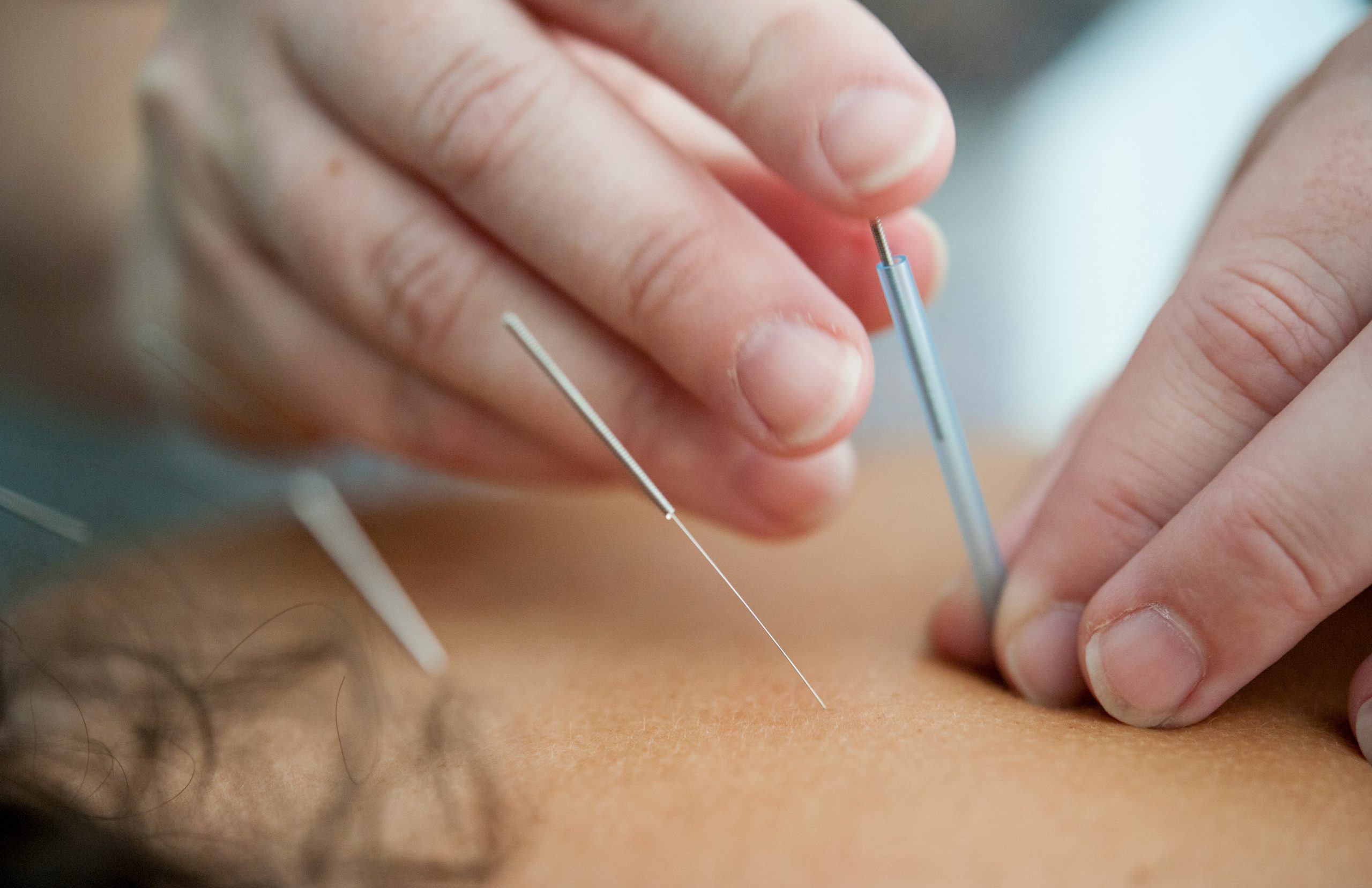 Close-up of hands placing thin acupuncture needles into someone's skin with precision, with additional needles already inserted visible in soft focus in the background